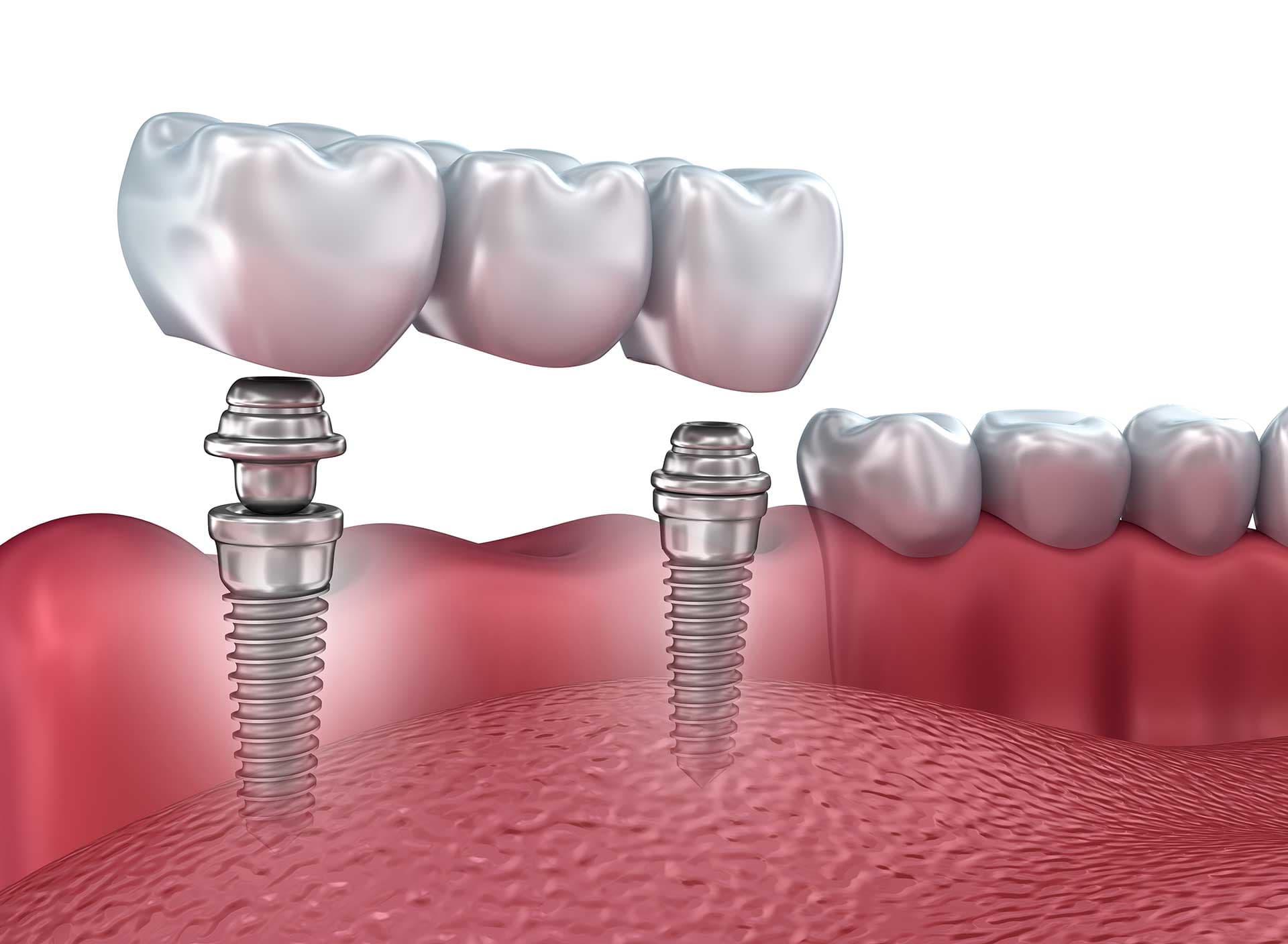 Dental implant model